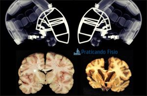 Estudos com jogadores de futebol americano confirmam danos cerebrais.