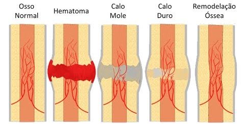 Calo ósseo