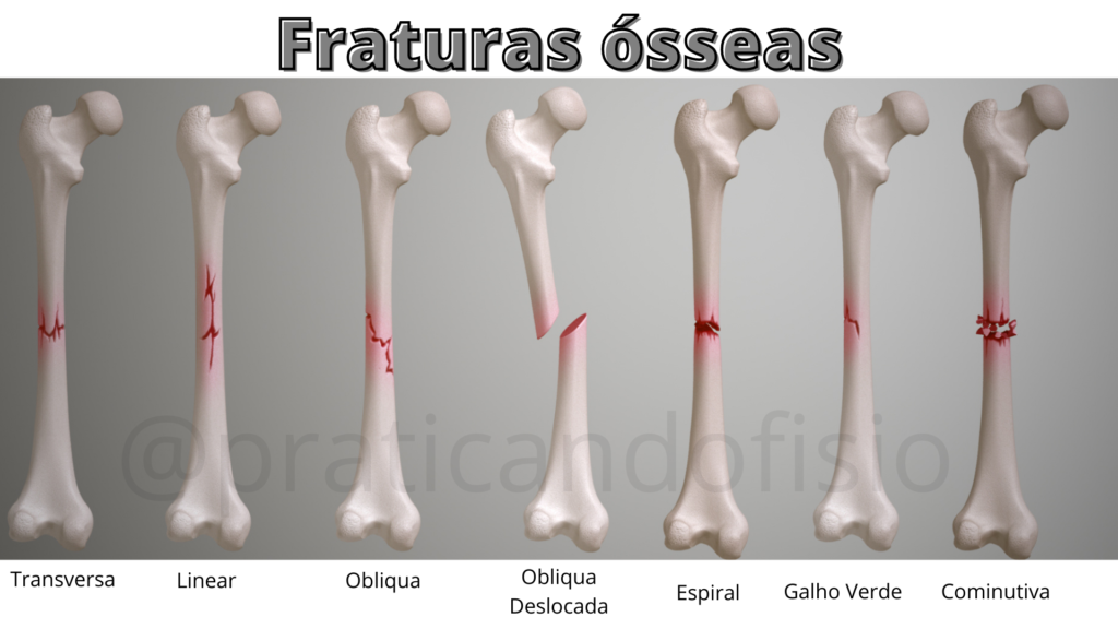 Tipos de fraturas ósseas
